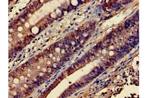 Immunohistochemistry of paraffin-embedded human colon cancer using ABIN7172843 at dilution of 1:100 (RHOA 抗体  (AA 1-191))