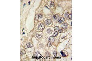 Formalin-fixed and paraffin-embedded human hepatocellular carcinoma tissue reacted with CDH6 polyclonal antibody , which was peroxidase-conjugated to the secondary antibody, followed by DAB staining. (CDH6 抗体  (C-Term))