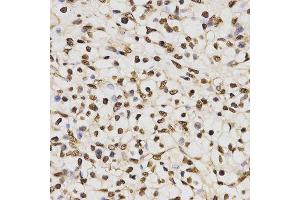 Immunohistochemistry of paraffin-embedded human kidney cancer tissue using H3R17me2a antibody at dilution of 1:200 (x400 lens) (Histone 3 抗体  (H3R17me2a))