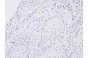 IHC-P Image Immunohistochemical analysis of paraffin-embedded Cal27 xenograft, using SENP2, antibody at 1:500 dilution. (SENP2 抗体  (N-Term))
