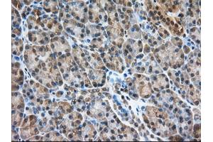 Immunohistochemical staining of paraffin-embedded Adenocarcinoma of Human colon tissue using anti-PDE4A mouse monoclonal antibody. (PDE4A 抗体)