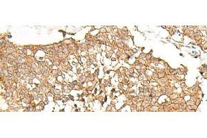 Immunohistochemistry of paraffin-embedded Human lung cancer tissue using PRLHR Polyclonal Antibody at dilution of 1:70(x200) (PRLHR 抗体)