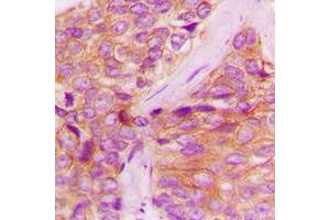 Immunohistochemical analysis of JAK1 (pY1022) staining in human breast cancer formalin fixed paraffin embedded tissue section. (JAK1 抗体  (C-Term, pTyr1022))
