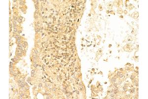 ABIN6259708 and ABIN6267079 at 1/100 staining Human lung cancer by IHC-P.