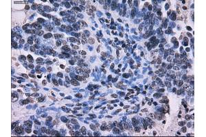 Immunohistochemical staining of paraffin-embedded Adenocarcinoma of colon tissue using anti-RPA2 mouse monoclonal antibody. (RPA2 抗体)