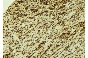 ABIN6269360 at 1/100 staining Human breast cancer tissue by IHC-P.