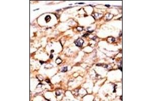 Formalin-fixed and paraffin-embedded human cancer tissue reacted with the primary antibody, which was peroxidase-conjugated to the secondary antibody, followed by AEC staining. (PGK2 抗体  (N-Term))