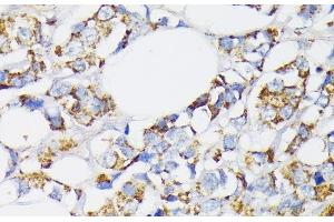 Immunohistochemistry of paraffin-embedded Human breast cancer using USP33 Polyclonal Antibody at dilution of 1:100 (40x lens). (USP33 抗体)