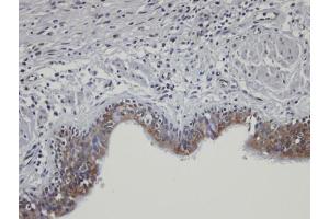 IHC-P Image Immunohistochemical analysis of paraffin-embedded PC13 xenograft, using SHKBP1, antibody at 1:100 dilution. (SHKBP1 抗体)