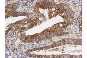 IHC-P Image Immunohistochemical analysis of paraffin-embedded human gastric cancer, using TSFM, antibody at 1:500 dilution. (TSFM 抗体)