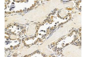 CTCF Mouse Monoclonal Antibody at 1/100 staining human ovarian cancer by IHC-P.