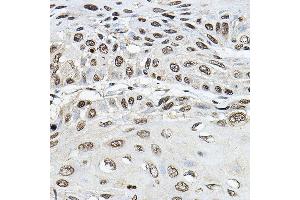 Immunohistochemistry of paraffin-embedded human esophageal cancer using TRRAP Rabbit pAb (ABIN7270906) at dilution of 1:100 (40x lens). (TRRAP 抗体)