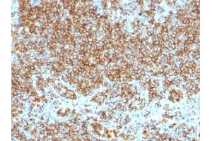 Formalin-fixed, paraffin-embedded human Lymphoma stained with CD45 Monoclonal Antibody (SPM569+SPM570). (CD45 抗体)