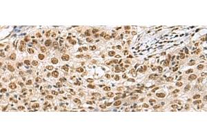 Immunohistochemistry of paraffin-embedded Human esophagus cancer tissue using PRPF40A Polyclonal Antibody at dilution of 1:60(x200) (PRPF40A 抗体)