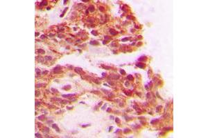 Immunohistochemical analysis of Carboxypeptidase A1 staining in human breast cancer formalin fixed paraffin embedded tissue section. (CPA1 抗体  (Center))