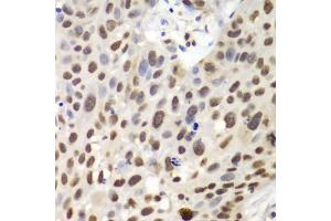 Immunohistochemistry of paraffin-embedded human lung cancer using GNB2L1 antibody.