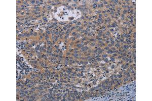 Immunohistochemistry of Human cervical cancer using PAPPA Polyclonal Antibody at dilution of 1:50 (PAPPA 抗体)
