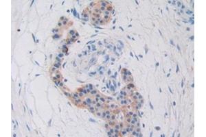 Detection of CYR61 in Human Pancreatic cancer Tissue using Polyclonal Antibody to Cysteine Rich Protein, Angiogenic Inducer 61 (CYR61) (CYR61 抗体  (AA 178-381))