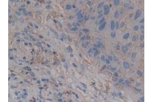 Detection of SDC1 in Human Lung cancer Tissue using Polyclonal Antibody to Syndecan 1 (SDC1) (Syndecan 1 抗体  (AA 23-253))