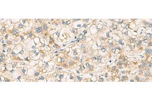 Immunohistochemistry of paraffin-embedded Human liver cancer tissue using PAFAH1B3 Polyclonal Antibody at dilution of 1:70(x200) (PAFAH1B3 抗体)