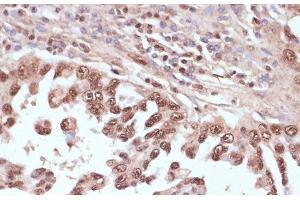 Immunohistochemistry of paraffin-embedded Human lung cancer using RAD50 Polyclonal Antibody at dilution of 1:100 (40x lens). (RAD50 抗体)