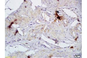 Formalin-fixed and paraffin embedded human cervical carcinoma labeled with Anti-CD72/Ly-32 Polyclonal Antibody, Unconjugated (ABIN741420) at 1:200 followed by conjugation to the secondary antibody and DAB staining (CD72 抗体  (AA 4-110))