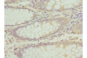 Immunohistochemistry of paraffin-embedded human colon cancer using ABIN7163515 at dilution of 1:100 (ATP2B2 抗体  (AA 1-80))