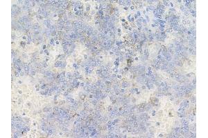 Phospho-TrkC (Tyr516) Antibody at 1/100 staining human melanoma by IHC-P.
