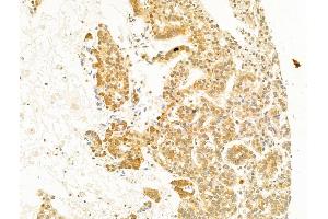ABIN6255488 and ABIN6267309 at 1/100 staining Human lung cancer by IHC-P. (C-JUN 抗体  (pSer73))