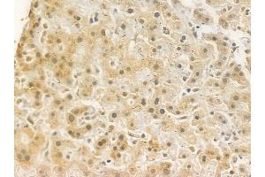 ABIN6262356 and ABIN6272323 at 1/100 staining human hepatocellular carcinoma by IHC-P. (HOXD8 抗体  (Internal Region))