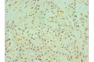 Immunohistochemistry of paraffin-embedded human breast cancer using ABIN7147014 at dilution of 1:100 (Cathepsin K 抗体  (AA 115-329))