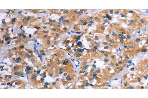 Immunohistochemistry of paraffin-embedded Human thyroid cancer using COMP Polyclonal Antibody at dilution of 1:50 (COMP 抗体)