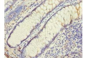 Immunohistochemistry of paraffin-embedded human colon cancer using ABIN7174455 at dilution of 1:100 (UBE2G2 抗体  (AA 1-165))