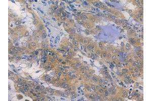 ABIN7096005 and ABIN7100067 at 1/100 staining human lung adenocarcinoma by IHC-P.