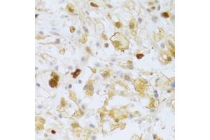 Immunohistochemistry of paraffin-embedded human brain astrocytoma using FCN1 Antibody (ABIN5973958) at dilution of 1/100 (40x lens). (FCN1 抗体)