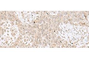 Immunohistochemistry of paraffin-embedded Human ovarian cancer tissue using RPL35 Polyclonal Antibody at dilution of 1:70(x200) (RPL35 抗体)