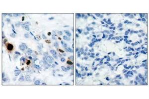 Immunohistochemical analysis of paraffin-embedded human breast carcinoma tissue using Histone H3. (Histone H3.1 抗体  (pSer10))