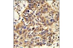 Formalin-fixed and paraffin-embedded human lung carcinoma reacted with CAT Antibody (Center), which was peroxidase-conjugated to the secondary antibody, followed by DAB staining. (Catalase 抗体  (AA 152-180))