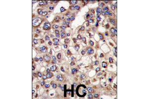 Formalin-fixed and paraffin-embedded human hepatocellular carcinoma reacted with MTMR4 polyclonal antibody  , which was peroxidase-conjugated to the secondary antibody, followed by DAB staining . (MTMR4 抗体  (C-Term))