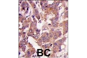 Formalin-fixed and paraffin-embedded human breast carcinoma tissue reacted with MEK1 Antibody (N-term) (ABIN1882177 and ABIN2842020) , which was peroxidase-conjugated to the secondary antibody, followed by DAB staining. (MEK1 抗体  (N-Term))