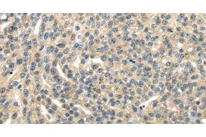 Immunohistochemistry of paraffin-embedded Human esophagus cancer tissue using RASA2 Polyclonal Antibody at dilution 1:45 (RASA2 抗体)