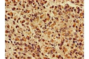 Immunohistochemistry of paraffin-embedded human glioma using ABIN7157603 at dilution of 1:100 (KIF17 抗体  (AA 500-777))