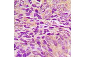 Immunohistochemical analysis of GRP75 staining in human breast cancer formalin fixed paraffin embedded tissue section. (HSPA9 抗体  (C-Term))