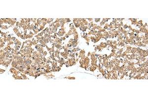 Immunohistochemistry of paraffin-embedded Human esophagus cancer tissue using NDUFB3 Polyclonal Antibody at dilution of 1:25(x200) (NDUFB3 抗体)