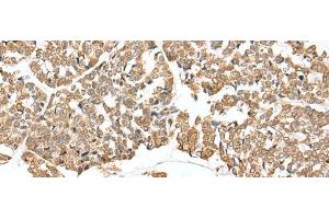 Immunohistochemistry of paraffin-embedded Human esophagus cancer tissue using NDUFB3 Polyclonal Antibody at dilution of 1:25(x200)