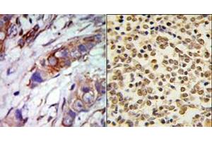 (LEFT)Formalin-fixed and paraffin-embedded human cancer tissue reacted with the primary antibody, which was peroxidase-conjugated to the secondary antibody, followed by AEC staining. (MAPK7 抗体  (C-Term))