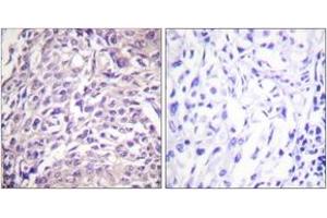 Immunohistochemistry analysis of paraffin-embedded human breast carcinoma tissue, using FOXO1A (Ab-329) Antibody.