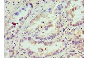 Immunohistochemistry of paraffin-embedded human lung cancer using ABIN7145712 at dilution of 1: 100 (CDCA8 抗体  (AA 1-280))