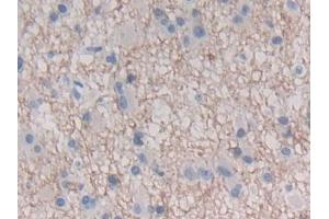 IHC-P analysis of Human Glioma Tissue, with DAB staining. (IFNE 抗体  (AA 30-208))