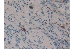 Detection of DNM2 in Human Lung cancer Tissue using Polyclonal Antibody to Dynamin 2 (DNM2)